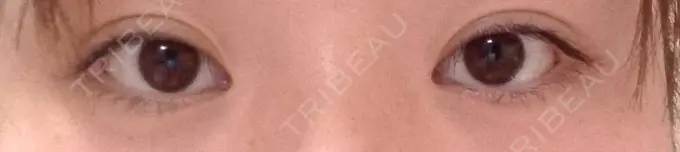 ヒアルロン酸注入（涙袋） フィラークリニック 大阪梅田院 DAY 122 メイン用