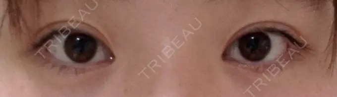 ヒアルロン酸注入（涙袋） フィラークリニック 大阪梅田院 DAY 122 メイン用