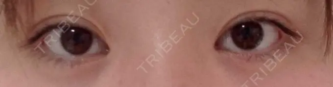 ヒアルロン酸注入（涙袋） フィラークリニック 大阪梅田院 AFTER メイン用