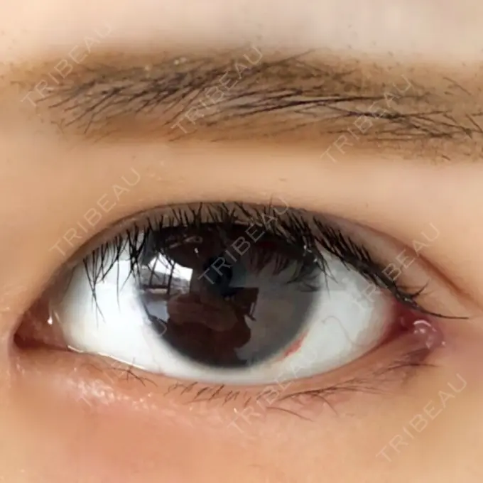 目頭切開 / 目尻切開 エートップ美容整形外科 DAY 14 メイン用