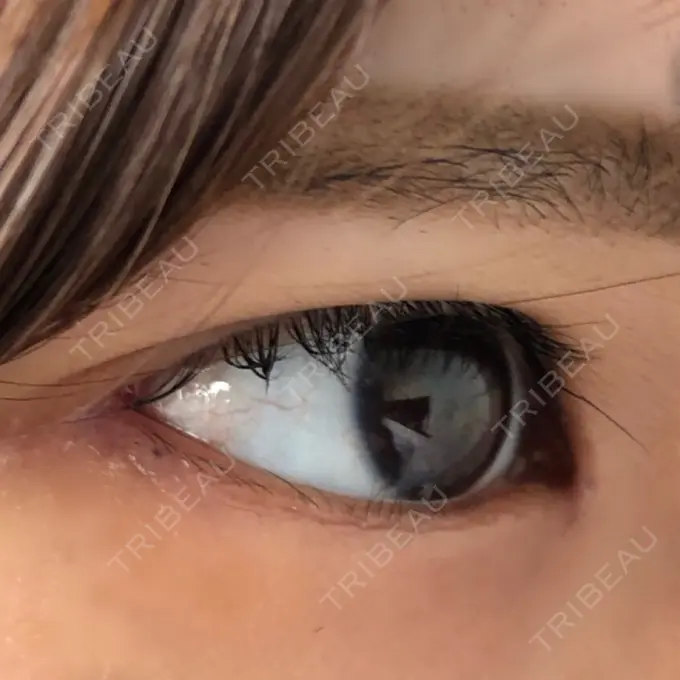 目頭切開 / 目尻切開 エートップ美容整形外科 DAY 14 メイン用