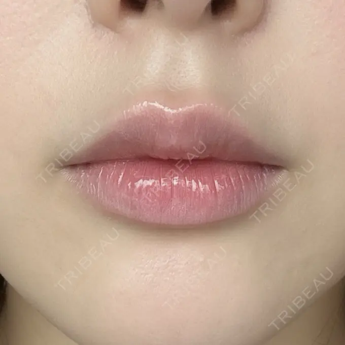 ヒアルロン酸注入（唇） ziz CLINIC AFTER メイン用