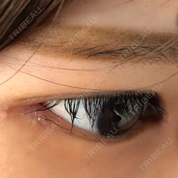 目頭切開 / 目尻切開 エートップ美容整形外科 DAY 14 メイン用