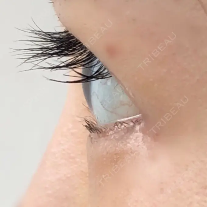 目頭切開 / 目尻切開 エートップ美容整形外科 DAY 18 メイン用