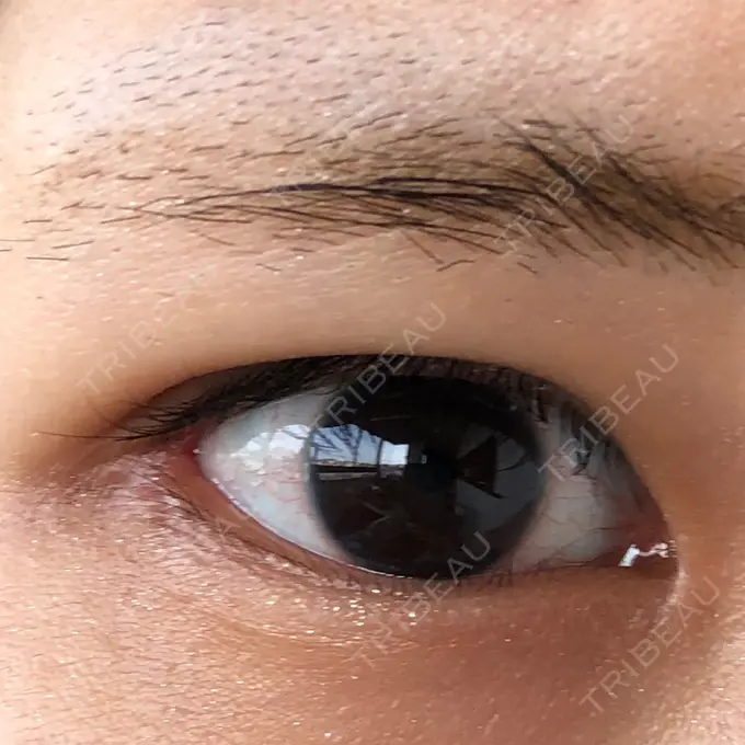 目頭切開 / 目尻切開 エートップ美容整形外科 DAY 29 メイン用