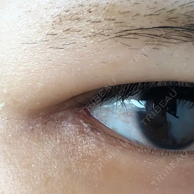 目頭切開 / 目尻切開 エートップ美容整形外科 DAY 29 メイン用