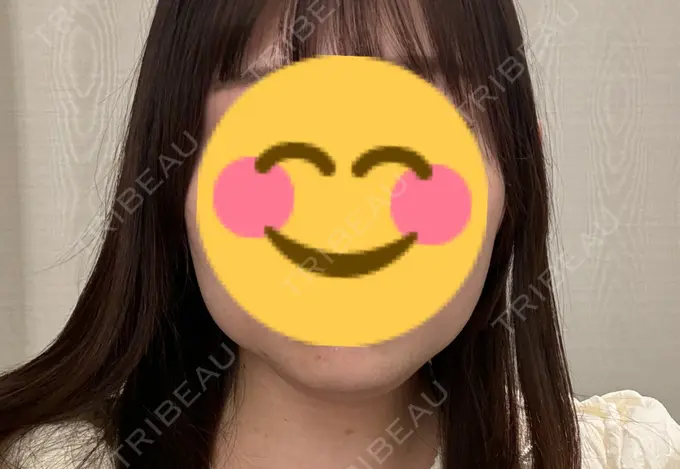 脂肪溶解注射（顔） 表参道ウィズ・クリニック DAY 0 メイン用