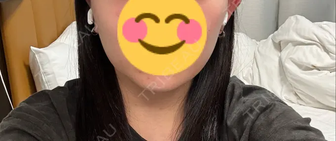 脂肪溶解注射（顔） 表参道ウィズ・クリニック DAY 16 メイン用