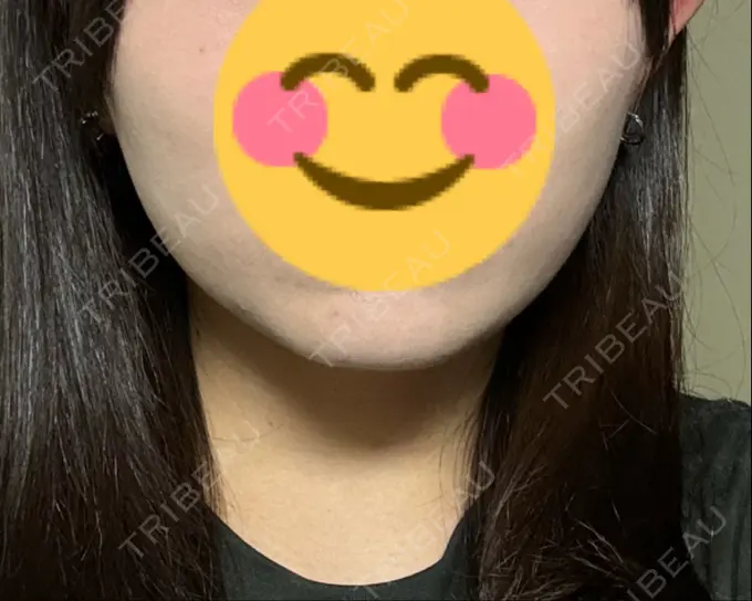 脂肪溶解注射（顔） 表参道ウィズ・クリニック AFTER メイン用