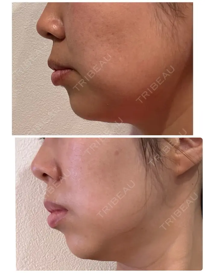 脂肪溶解注射（顔） 表参道ウィズ・クリニック DAY 6 メイン用