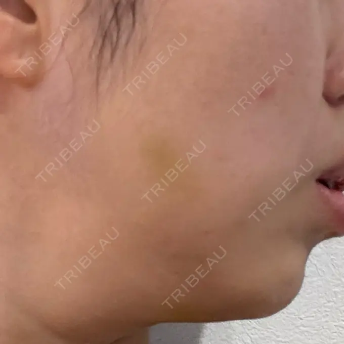 脂肪溶解注射（顔） 表参道ウィズ・クリニック DAY 6 メイン用