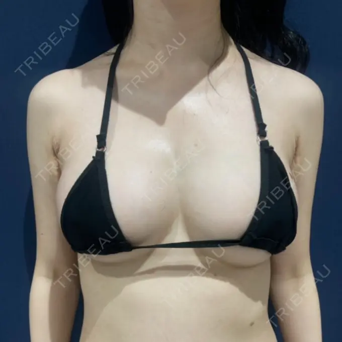 脂肪吸引（二の腕） / 脂肪吸引（脚） / 豊胸（脂肪注入） / 脂肪注入（肌） / こめかみ形成 / 脂肪吸引（肩） / 脂肪注入（目の下） / 脂肪注入（輪郭） ICON CLINIC DAY 40 メイン用