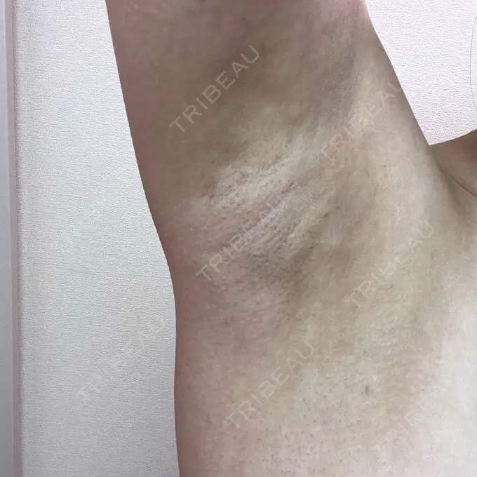 ワキ汗治療（レーザー） Fellez Clinic【フェルズクリニック】 DAY 22 メイン用