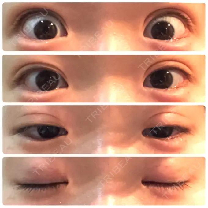 二重埋没 湘南美容クリニック 新宿本院 DAY 18 メイン用