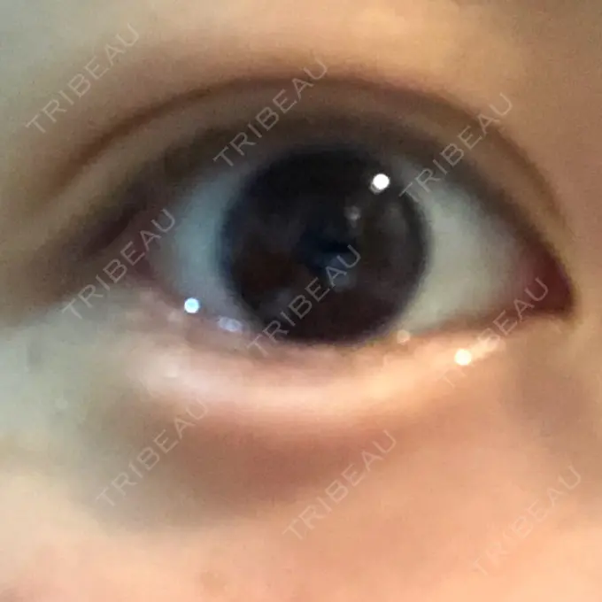 ヒアルロン酸注入（涙袋） フィラークリニック 新宿院 DAY 0 メイン用