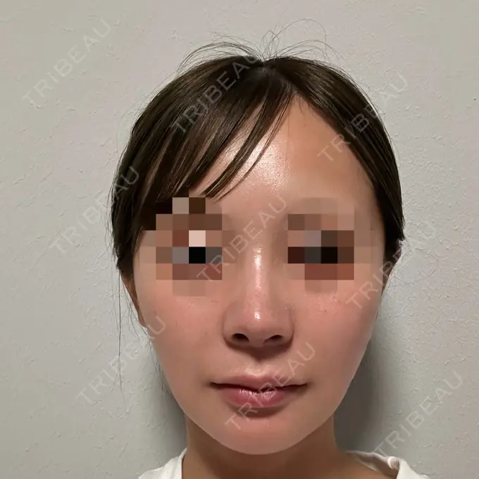 隆鼻術 / 鼻尖形成（切開） / 鼻中隔延長（切開） / 軟骨移植 / 鼻修正 / 鼻孔縁下降 / その他（鼻） Designo Clinic （デジーノクリニック） DAY 20 メイン用