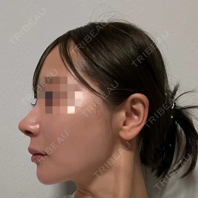 隆鼻術 / 鼻尖形成（切開） / 鼻中隔延長（切開） / 軟骨移植 / 鼻修正 / 鼻孔縁下降 / その他（鼻） Designo Clinic （デジーノクリニック） DAY 20 メイン用