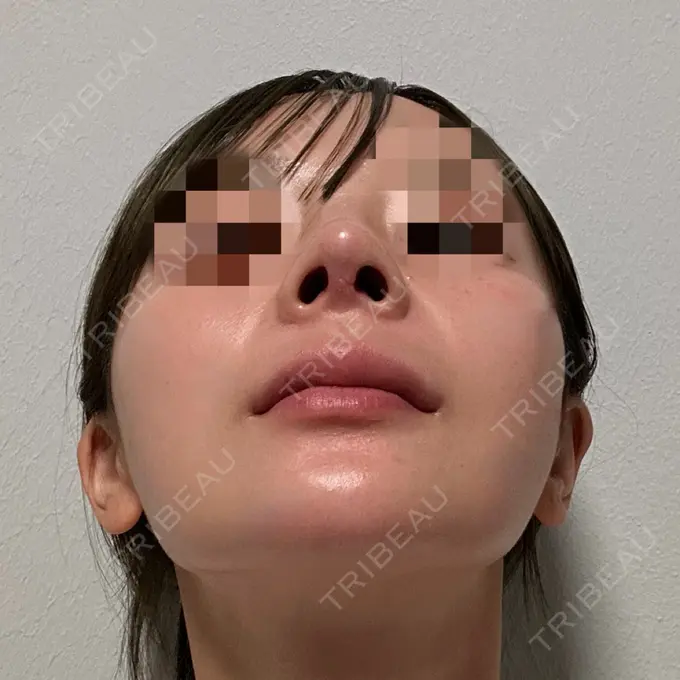 隆鼻術 / 鼻尖形成（切開） / 鼻中隔延長（切開） / 軟骨移植 / 鼻修正 / 鼻孔縁下降 / その他（鼻） Designo Clinic （デジーノクリニック） DAY 20 メイン用