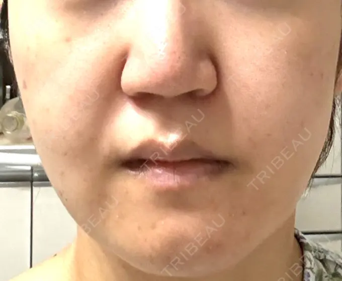 脂肪吸引（顔） スノウ（Snow）整形外科 DAY 46 メイン用