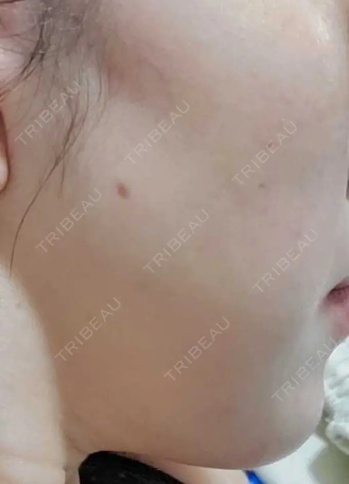 ほくろ・いぼ除去レーザー（肌） Mavie Beauty Clinic （マヴィービューティークリニック） DAY 14 メイン用