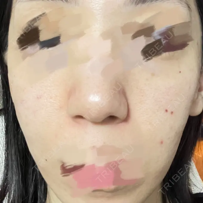 毛穴洗浄（ハイドラフェイシャルなど） 日本美容・医療クリニック 六本木院 AFTER メイン用