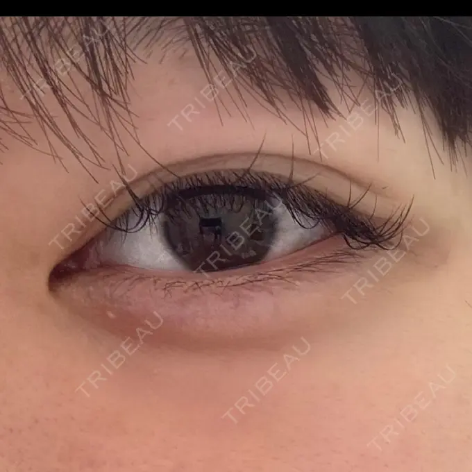 ヒアルロン酸注入（涙袋） / ボトックス（エラ・小顔） / ボトックス（口角） / ボトックス（肩） ルヴィクリニック イオンドーム前院 DAY 2 メイン用