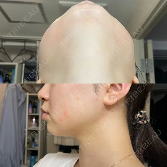 RF（高周波）たるみ治療 ライブリークリニック 浜松町院 DAY 2 メイン用