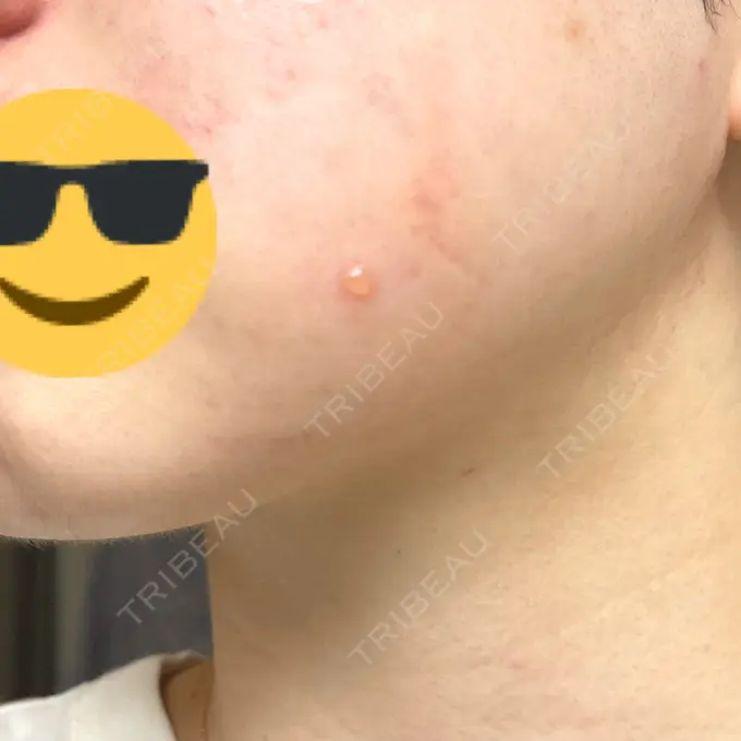 RF（高周波）たるみ治療 ライブリークリニック 浜松町院 DAY 2 メイン用