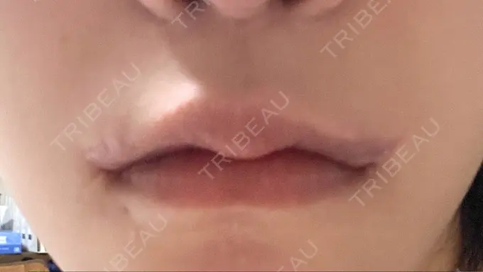 口角挙上 くさのたろうクリニック DAY 31 メイン用