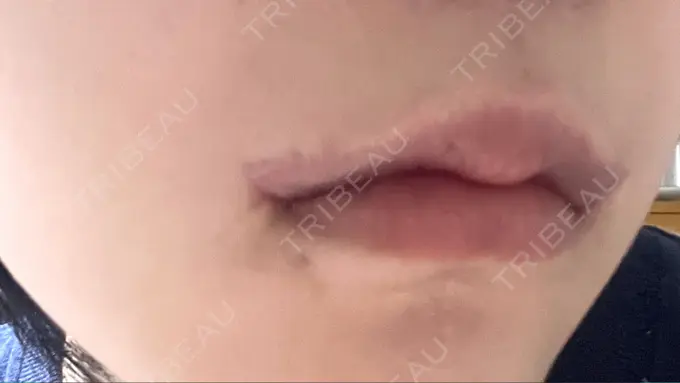 口角挙上 くさのたろうクリニック DAY 31 メイン用