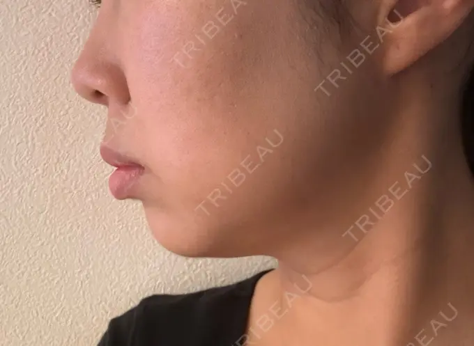 脂肪溶解注射（顔） 表参道ウィズ・クリニック AFTER メイン用