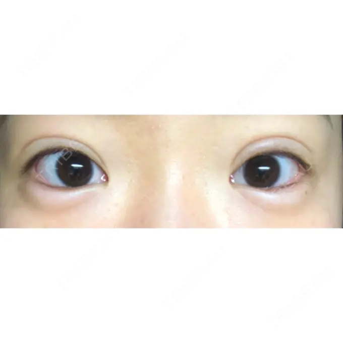 ヒアルロン酸注入（涙袋） フィラークリニック 新宿院 AFTER メイン用