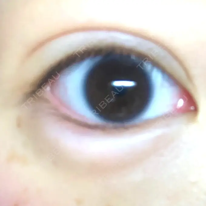 ヒアルロン酸注入（涙袋） フィラークリニック 新宿院 DAY 1 メイン用