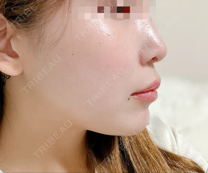 ハイフ（顔） 東京シンデレラ美容外科 大宮院 AFTER メイン用