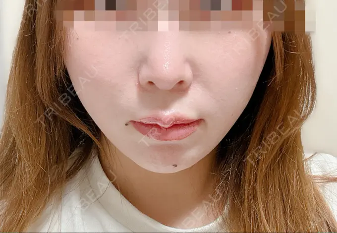 ハイフ（顔） 東京シンデレラ美容外科 大宮院 DAY 30 メイン用