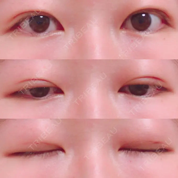 二重埋没 湘南美容クリニック 東京蒲田院 DAY 46 メイン用