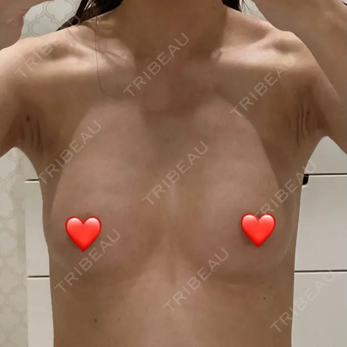 脂肪吸引（脚） / 豊胸（脂肪注入） Mods Clinic（モッズクリニック） 名古屋院 DAY 31 メイン用