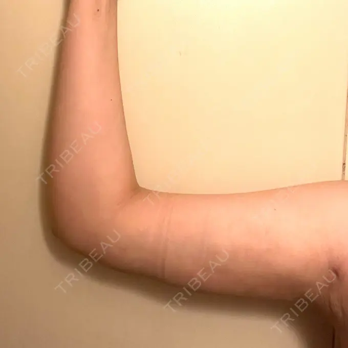 脂肪吸引（二の腕） アムルーズ美容外科クリニック 横浜院 AFTER メイン用