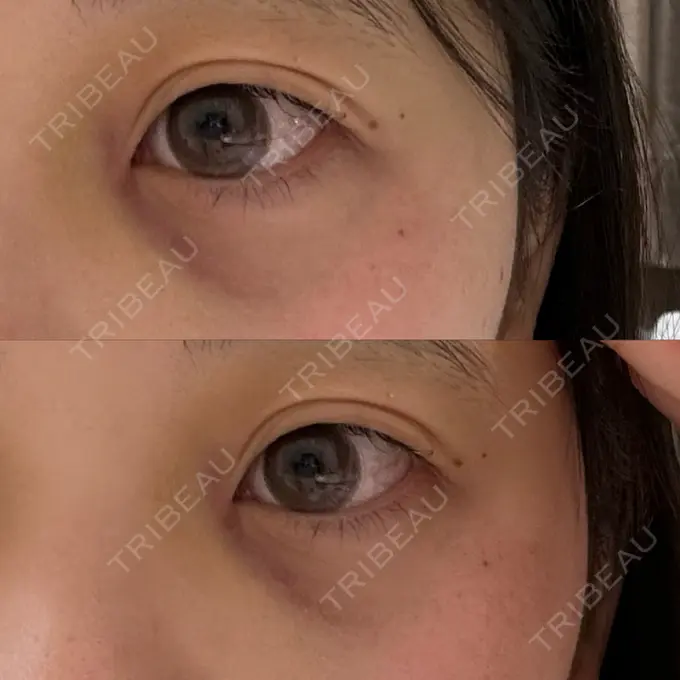 額を丸く / ヒアルロン酸注入（こめかみ） ハナビューティークリニック DAY 4 メイン用