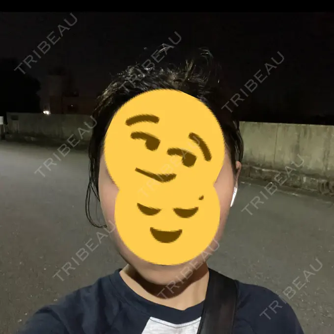 糸リフト / バッカルファット除去 / 脂肪吸引（顔） / ボトックス（エラ・小顔） RIVER CLINIC（リバークリニック） AFTER メイン用