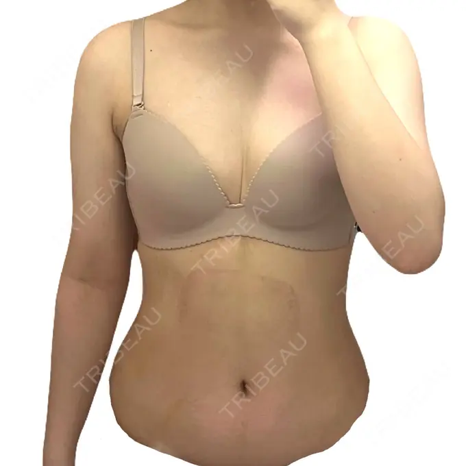 脂肪冷却（お腹） DMTC CLINIC 日本橋院 AFTER メイン用