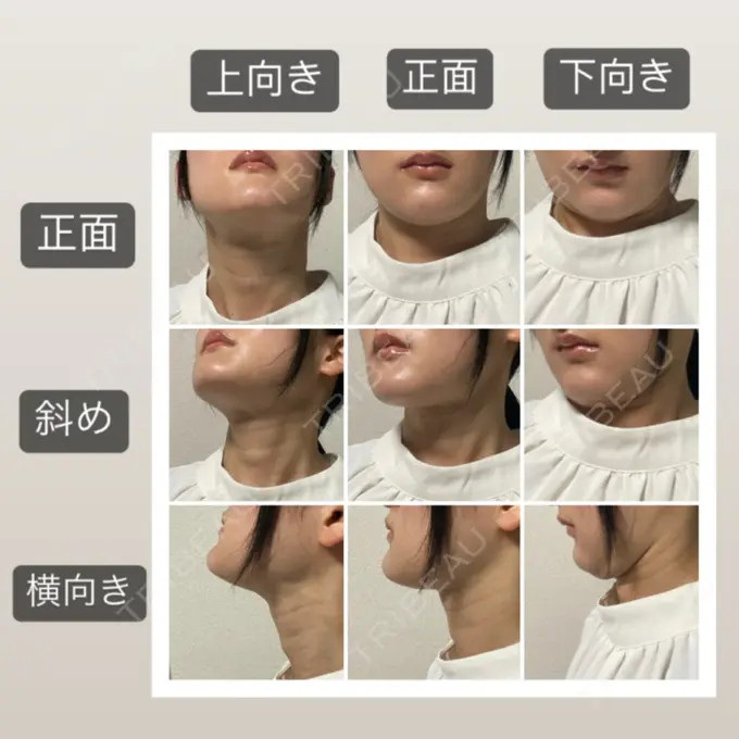 脂肪吸引（顔） 湘南美容クリニック 秋葉原院 DAY 56 メイン用