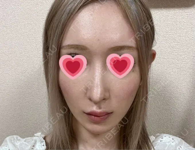 鼻尖形成（切開） / 軟骨移植 / 骨切幅寄せ / ワシ鼻修正・ハンプ切除 銀座マイアミ美容外科 DAY 49 メイン用