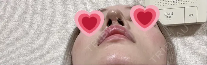 鼻尖形成（切開） / 軟骨移植 / 骨切幅寄せ / ワシ鼻修正・ハンプ切除 銀座マイアミ美容外科 DAY 49 メイン用