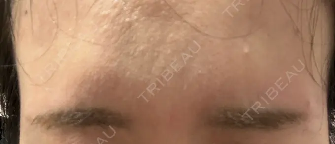 シワ取りボトックス 静岡中央クリニック AFTER メイン用