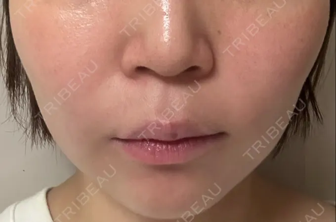 医療痩身（顔） / その他（輪郭） ライブリークリニック 浜松町院 DAY 1 メイン用