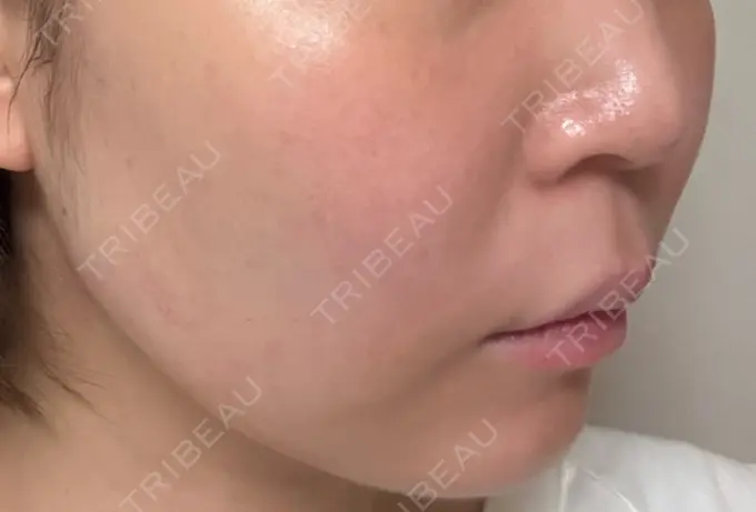 医療痩身（顔） / その他（輪郭） ライブリークリニック 浜松町院 DAY 1 メイン用