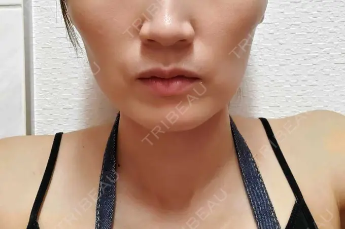 ボトックス（エラ・小顔） / ピーリング（ニキビ・毛穴） / イオン導入 ルラ美容クリニック 上野院 AFTER メイン用