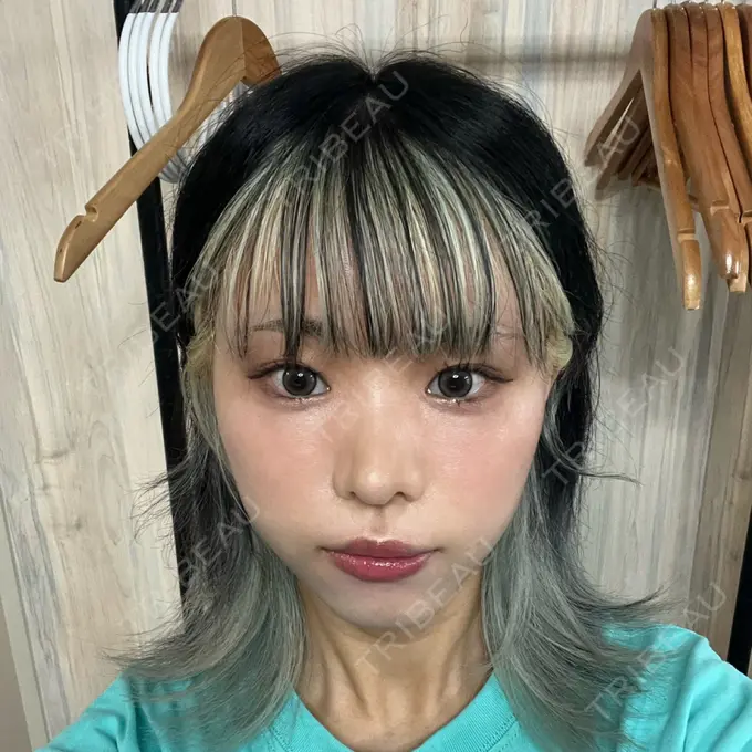 クマ治療 / 脂肪注入（額） / 脂肪注入（輪郭） X CLINIC 名古屋院 DAY 49 メイン用