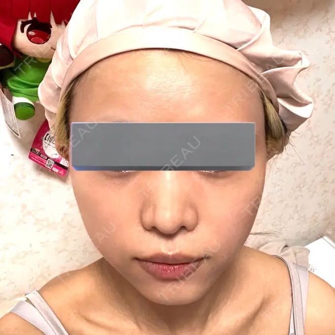 クマ治療 / 脂肪注入（額） / 脂肪注入（輪郭） X CLINIC 名古屋院 DAY 53 メイン用